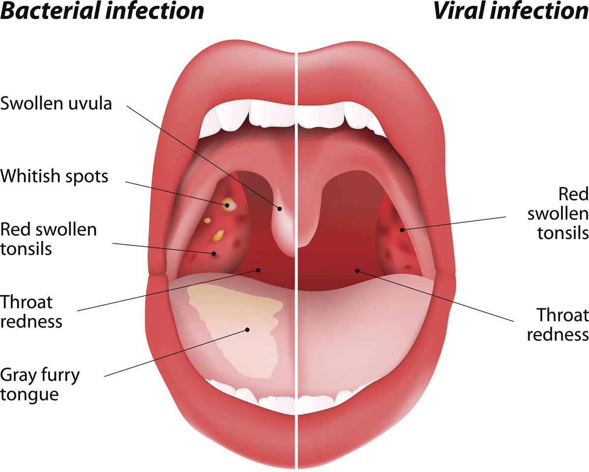 Bakterie/virus v krku – rozdíly. Zdroj fotografií: Getty Images Viry a bakterie v krku - rozdíly